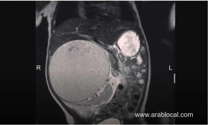 10cm-tumour-removed-from-baby’s-abdomen_bahrain