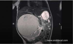 10cm-tumour-removed-from-baby’s-abdomen_bahrain