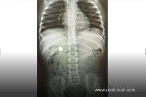 child-saved-after-swallowing-battery_bahrain