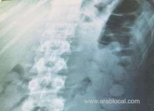 man-accused-of-smuggling-drug-in-stomach_bahrain